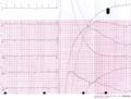 Cardioversion from atrial fibrillation to sinus rhythm, with clear baseline drift.