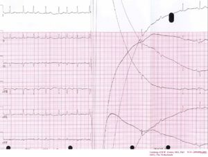Cardioversion from afib.jpg