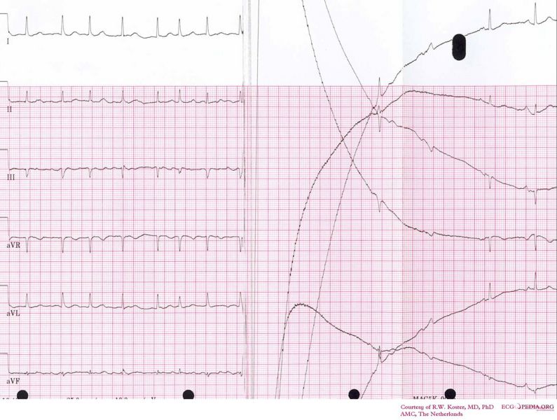 File:Cardioversion from afib.jpg
