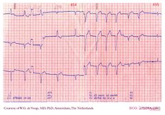 De Voogt ECG Archive - Intraventricular Conduction - ECGpedia