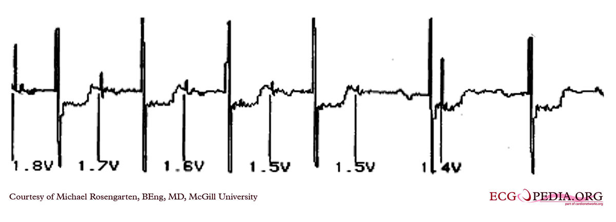 Mcgill Case 290 Ecgpedia