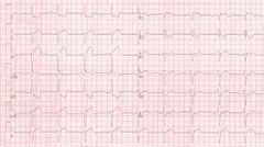 MI Diagnosis in RBBB - ECGpedia