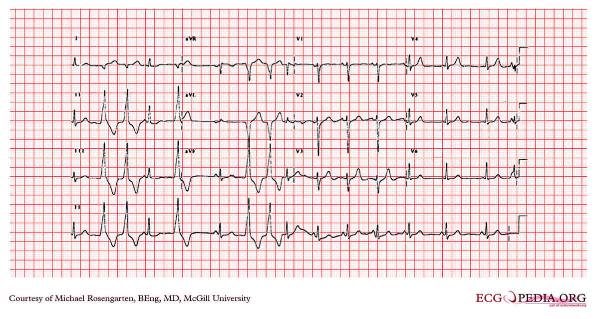 File:E000784.jpg - ECGpedia