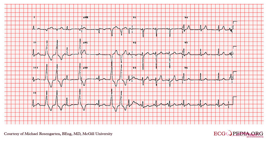 McGill Case 83 - ECGpedia