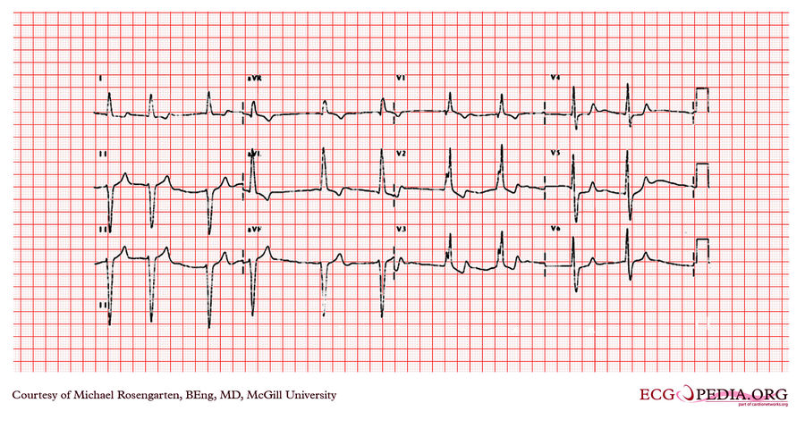 Mcgill Case 243 Ecgpedia