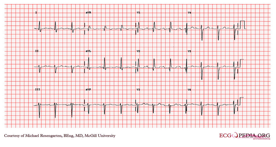 McGill Case 333 - ECGpedia