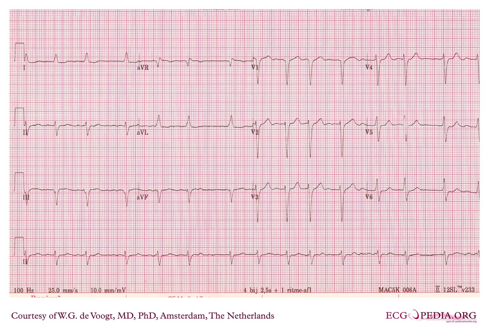 File:DVA0505.jpg - ECGpedia