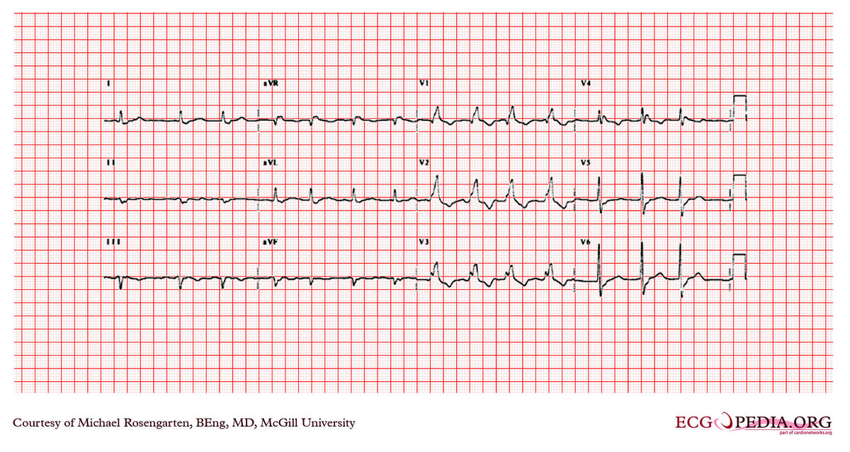 Mcgill Case 206 - Ecgpedia