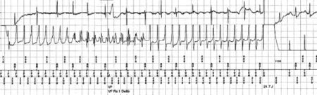 Puzzle 2004 10 469 - Answer - ECGpedia