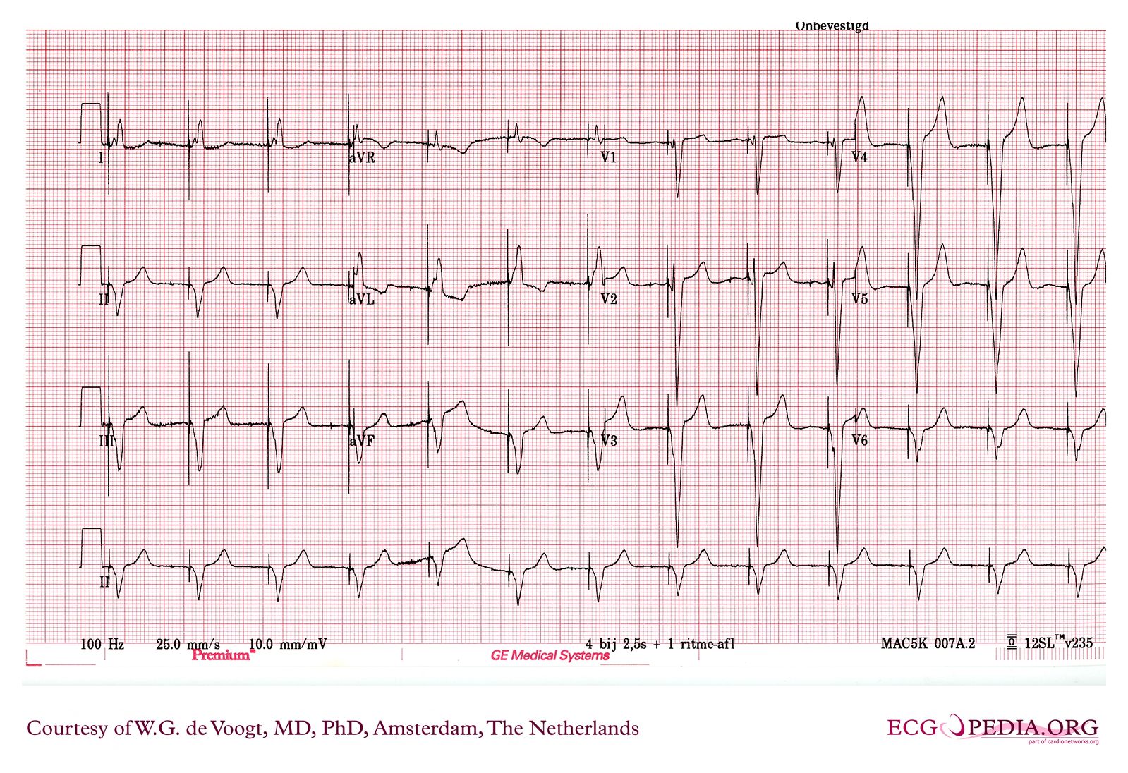 File:DVA1096.jpg - ECGpedia