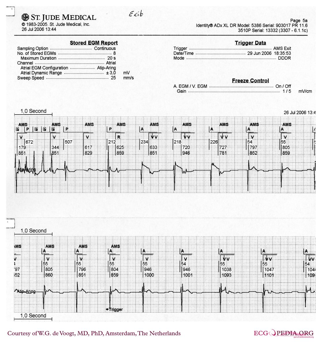 File:DVA1010.jpg - ECGpedia