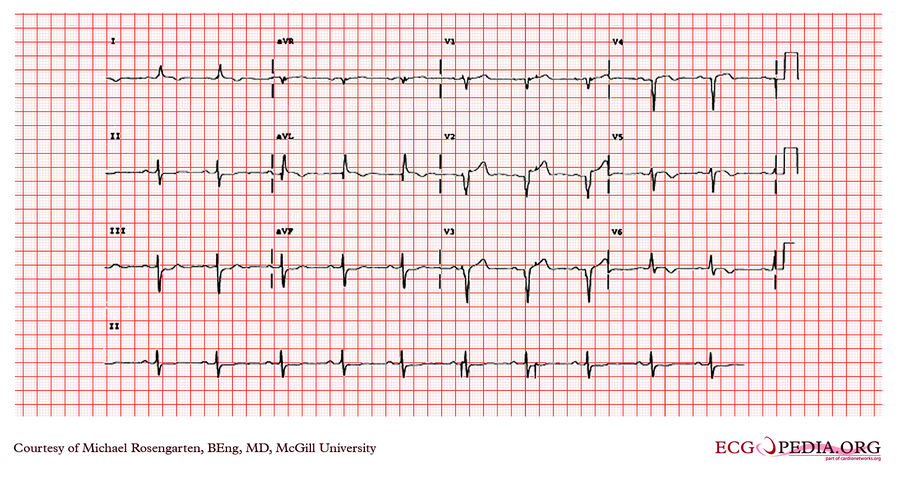 McGill Case 126 - ECGpedia