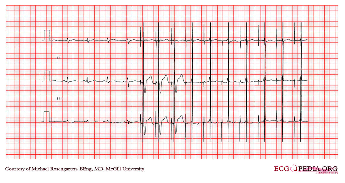 McGill Case 320 - ECGpedia