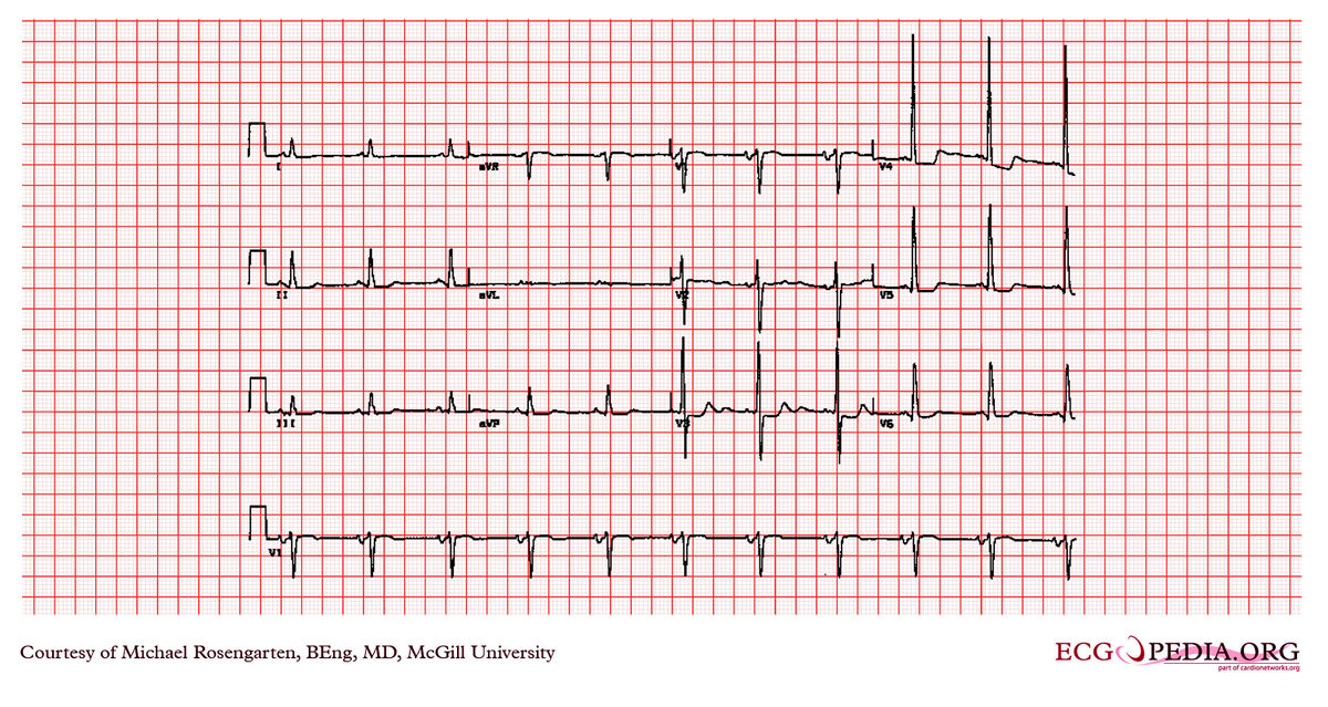 McGill Case 307 - ECGpedia