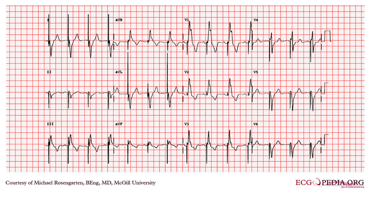 McGill Case 322 - ECGpedia