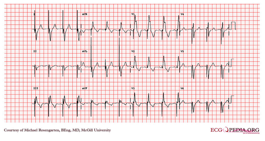 McGill Case 322 - ECGpedia