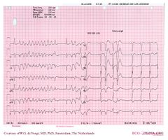 De Voogt ECG Archive - Genetic Arrhythmias - ECGpedia