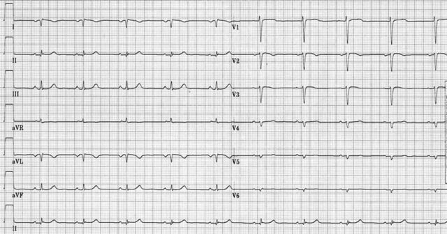 File:Puzzle 2007 12 426 fig1.jpg - ECGpedia