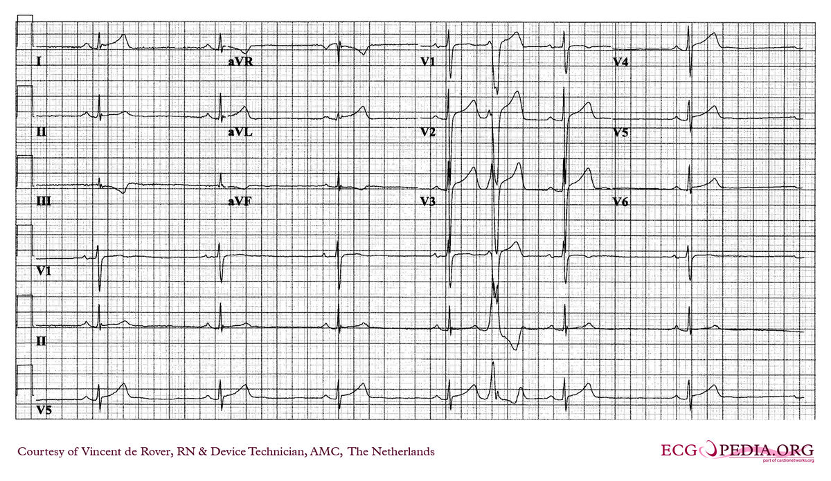 AMC Case 246 - ECGpedia