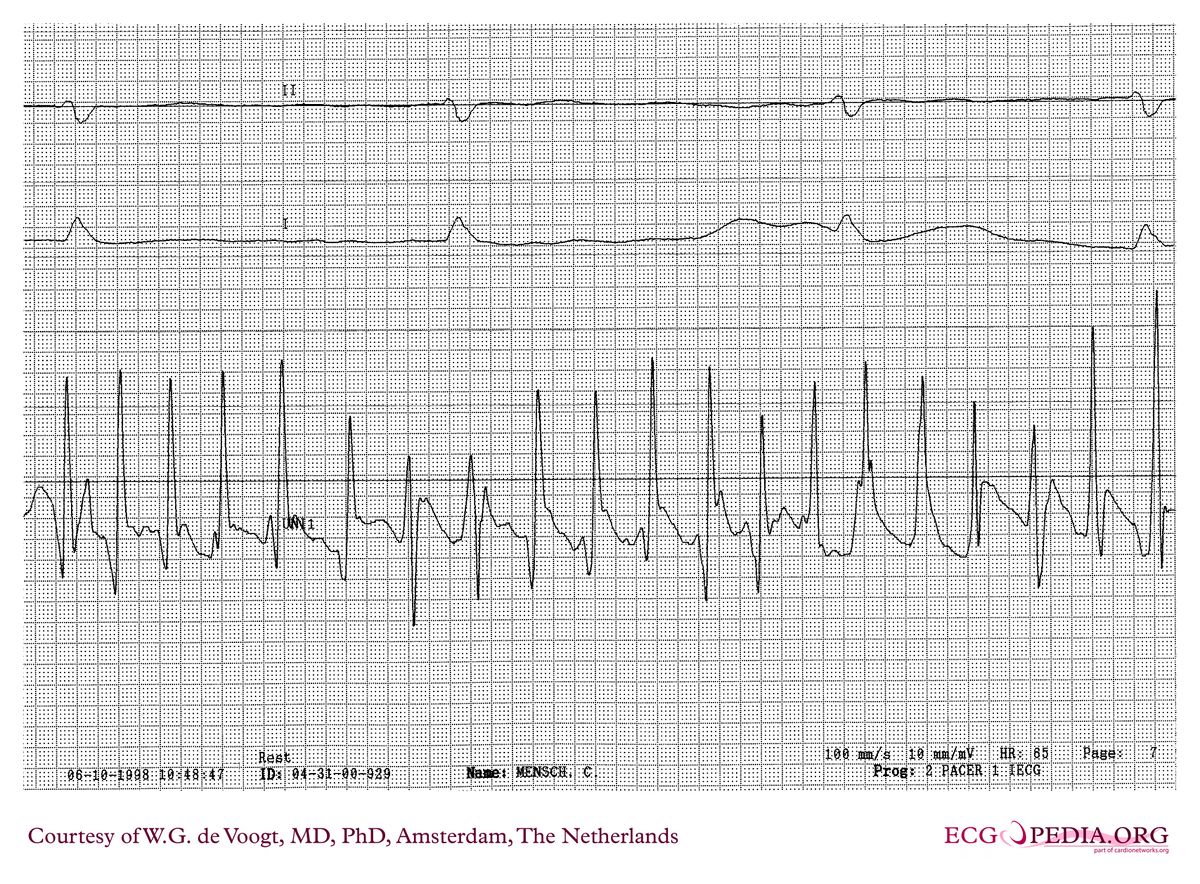 File:DVA0189.jpg - ECGpedia