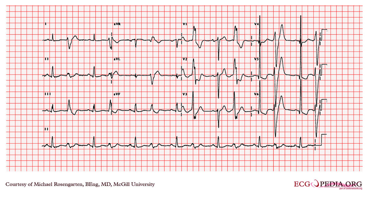 McGill Case 79 - ECGpedia