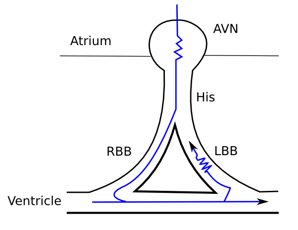 Intraventricular Conduction - ECGpedia