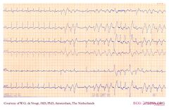 De Voogt ECG Archive - Supraventricular Rhythms - AVNRT - ECGpedia