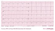 De Voogt ECG Archive - Electrolyte Disorders - ECGpedia