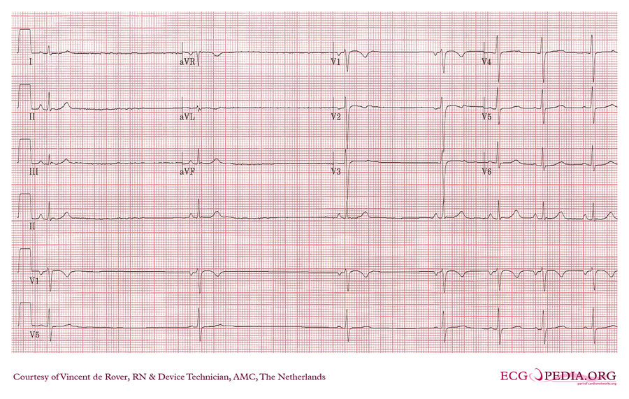 AMC Case 99 - ECGpedia