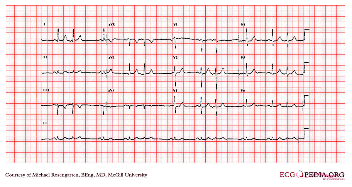 File:E000747.jpg - ECGpedia