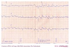 De Voogt ECG Archive - Myocardial Infarction - Anterior - ECGpedia