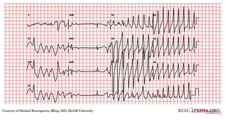 McGill Case 86 - ECGpedia