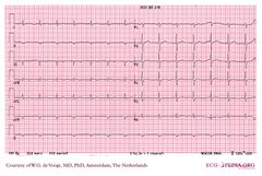 De Voogt ECG Archive - Ventricular Arrhythmias - ECGpedia