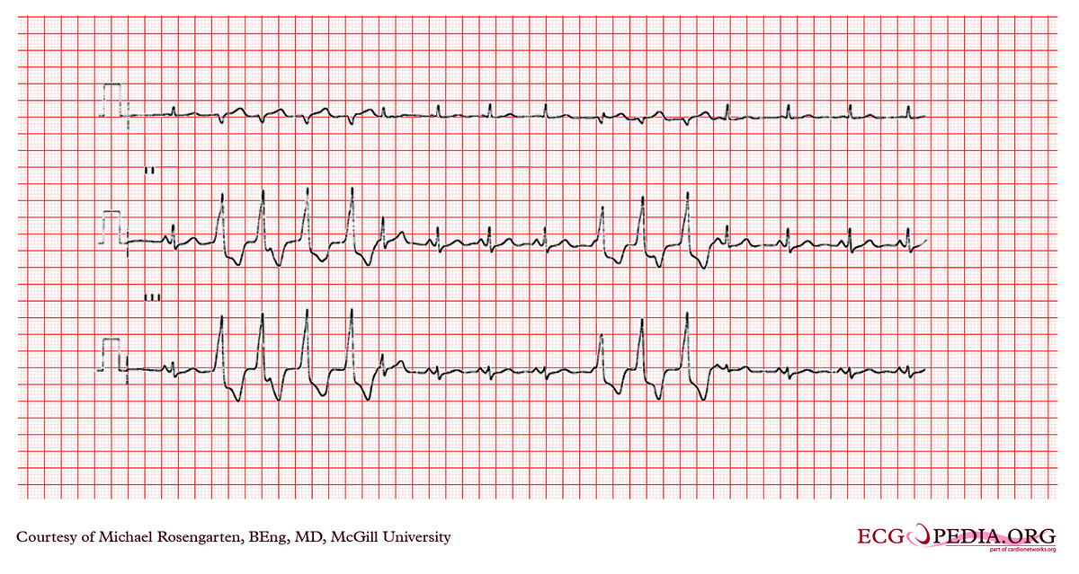 mcgill-case-220-ecgpedia