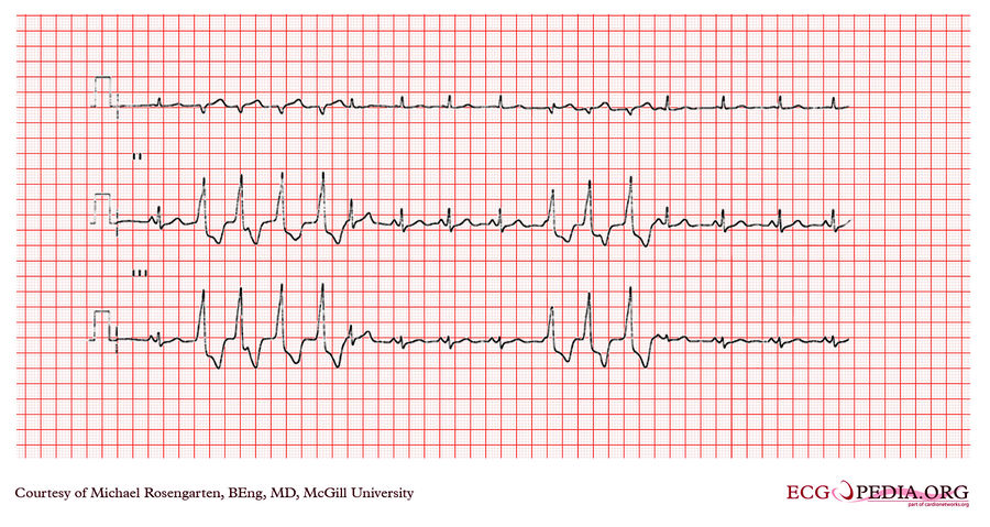 McGill Case 220 - ECGpedia