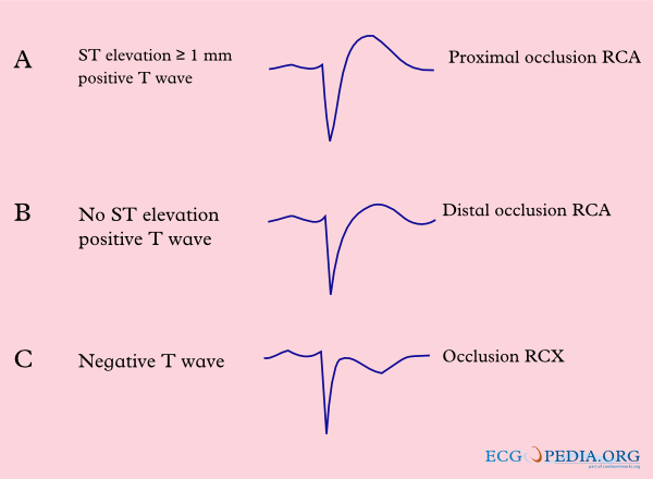 Inferior MI - ECGpedia