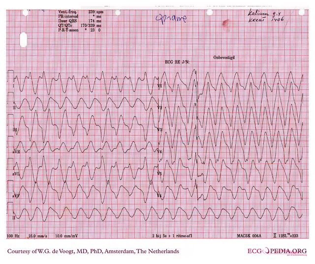 File:DVA0578.jpg - ECGpedia