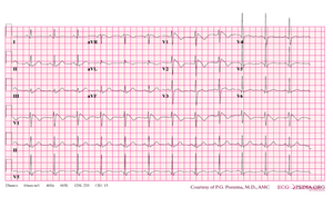 De-Brugada syndrome type1 example4.png