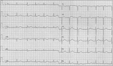 Puzzle 2004 10 469 - Answer - ECGpedia