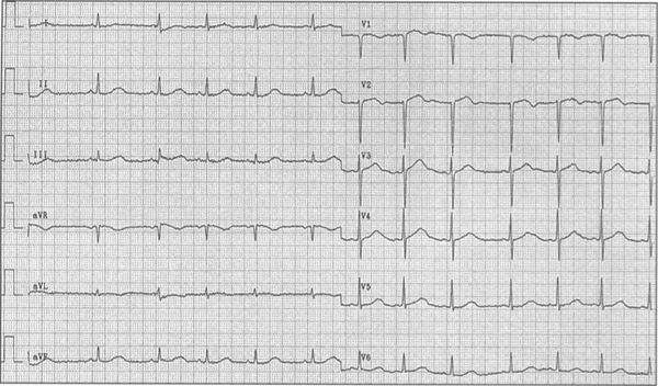 I Think a Niece of Mine was Referred to a Neurologist - ECGpedia