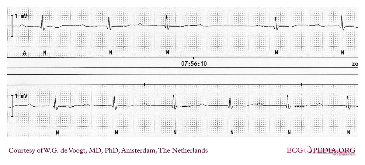 File:DVA1797.jpg - ECGpedia