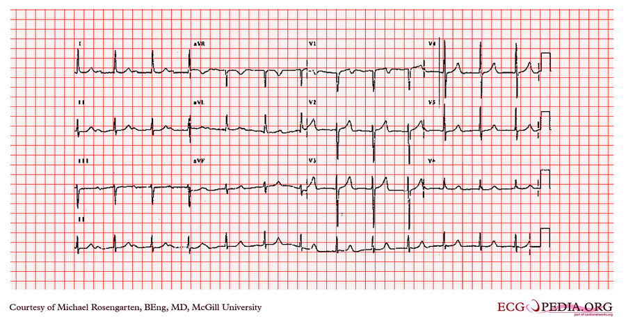 McGill Case 346 - ECGpedia