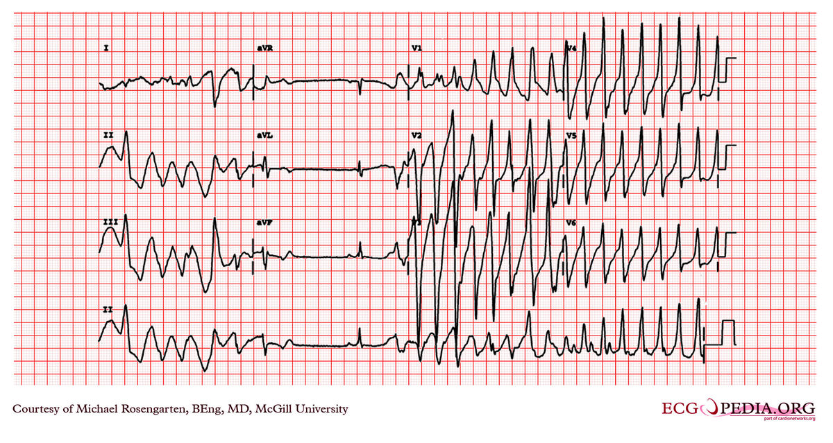 McGill Case 302 - ECGpedia