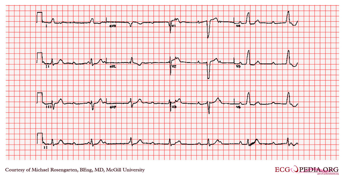 File:E312.jpg - ECGpedia