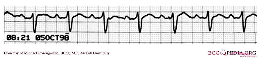 McGill Case 131 - ECGpedia