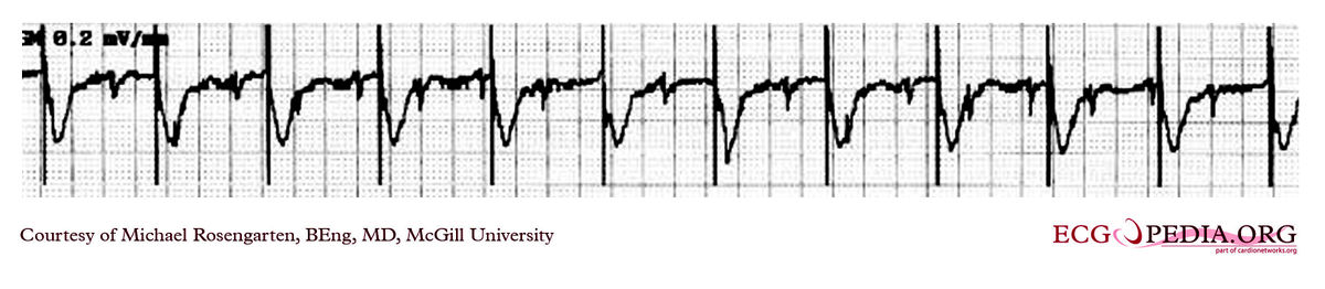 McGill Case 293 - ECGpedia