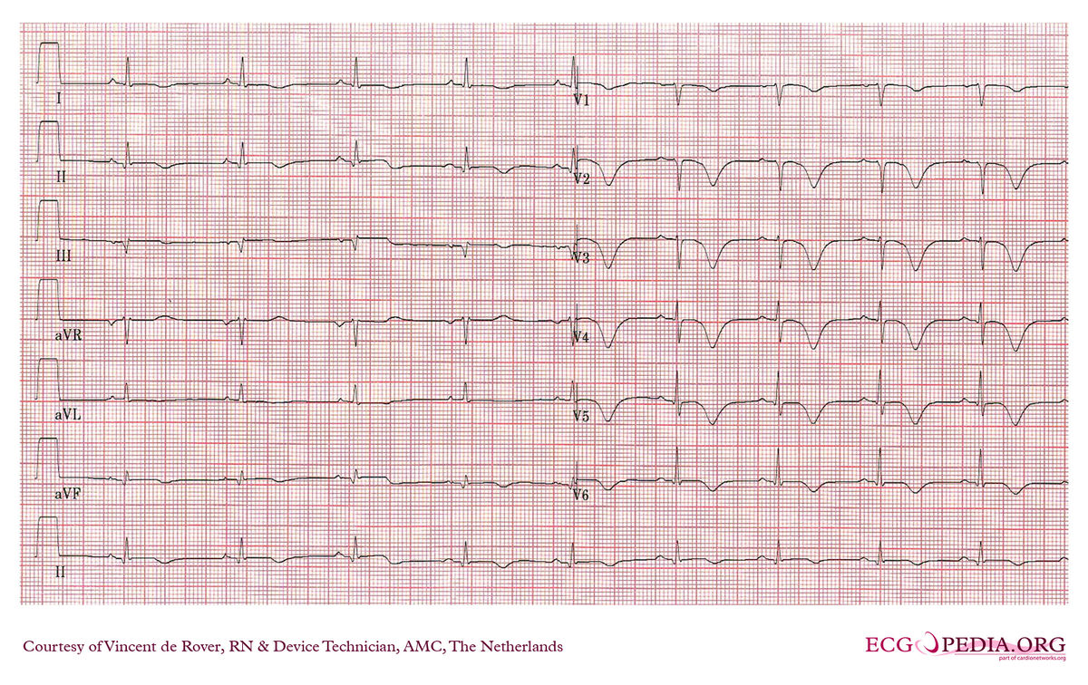 AMC Case 207 - ECGpedia