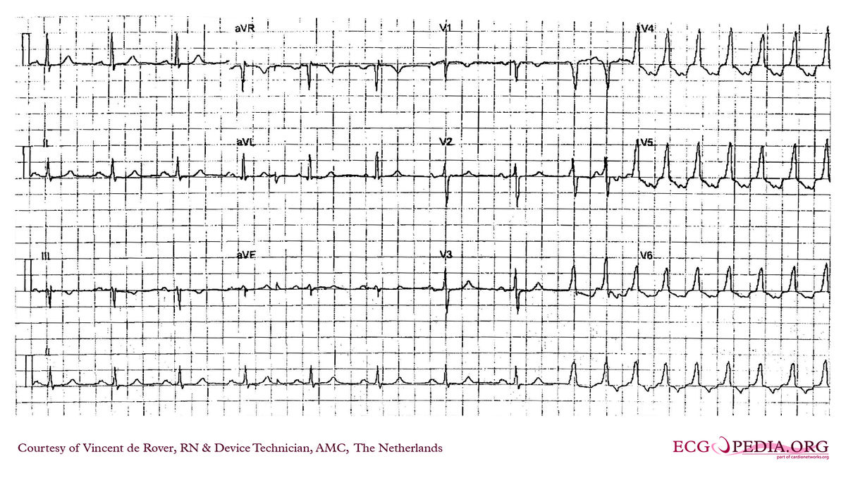 AMC Case 255 - ECGpedia