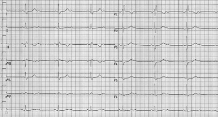 Syncope in an Old Lady - ECGpedia