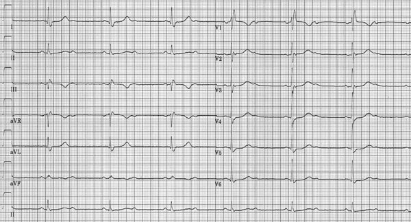 Syncope in an Old Lady - ECGpedia